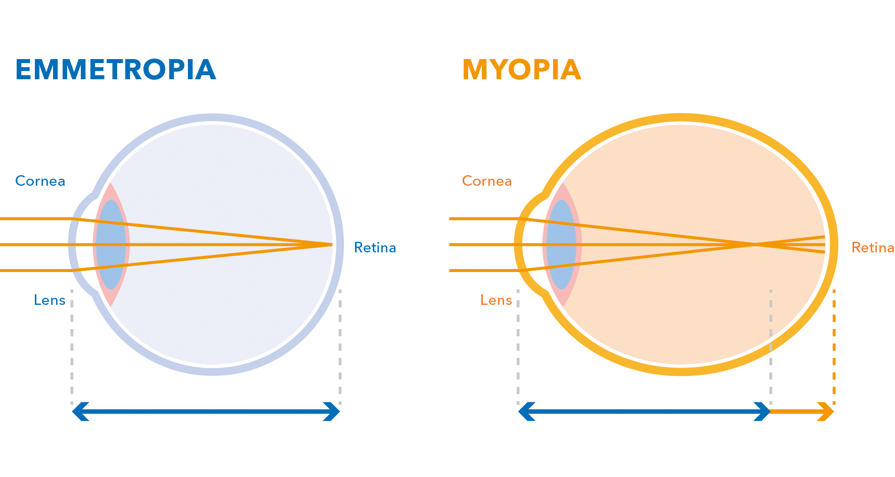 MYOPIA1 MYOPIA1